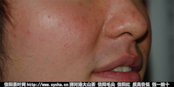 痘印怎么消除小妙招 去痘印小妙招
